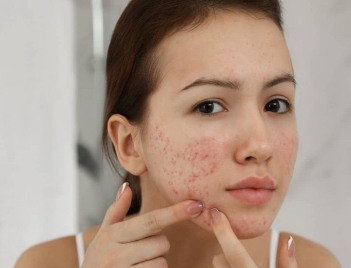 18 tuổi nên uống loại collagen nào để ngăn ngừa mụn?